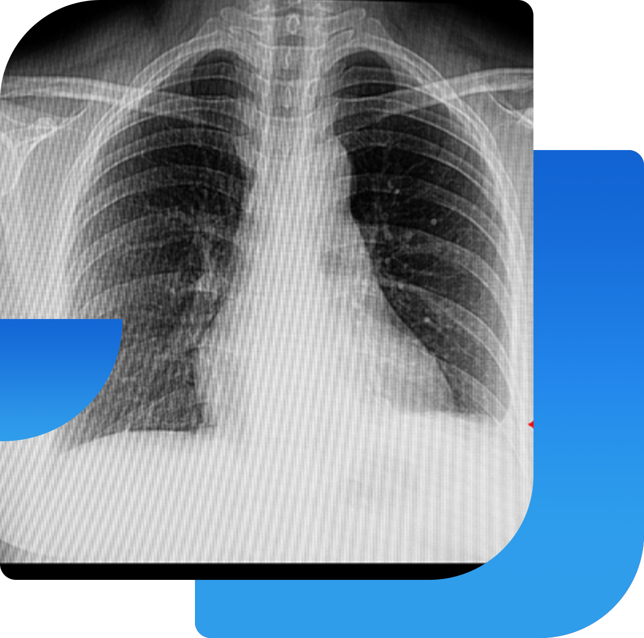 Pleural Adhesiolysis (1)