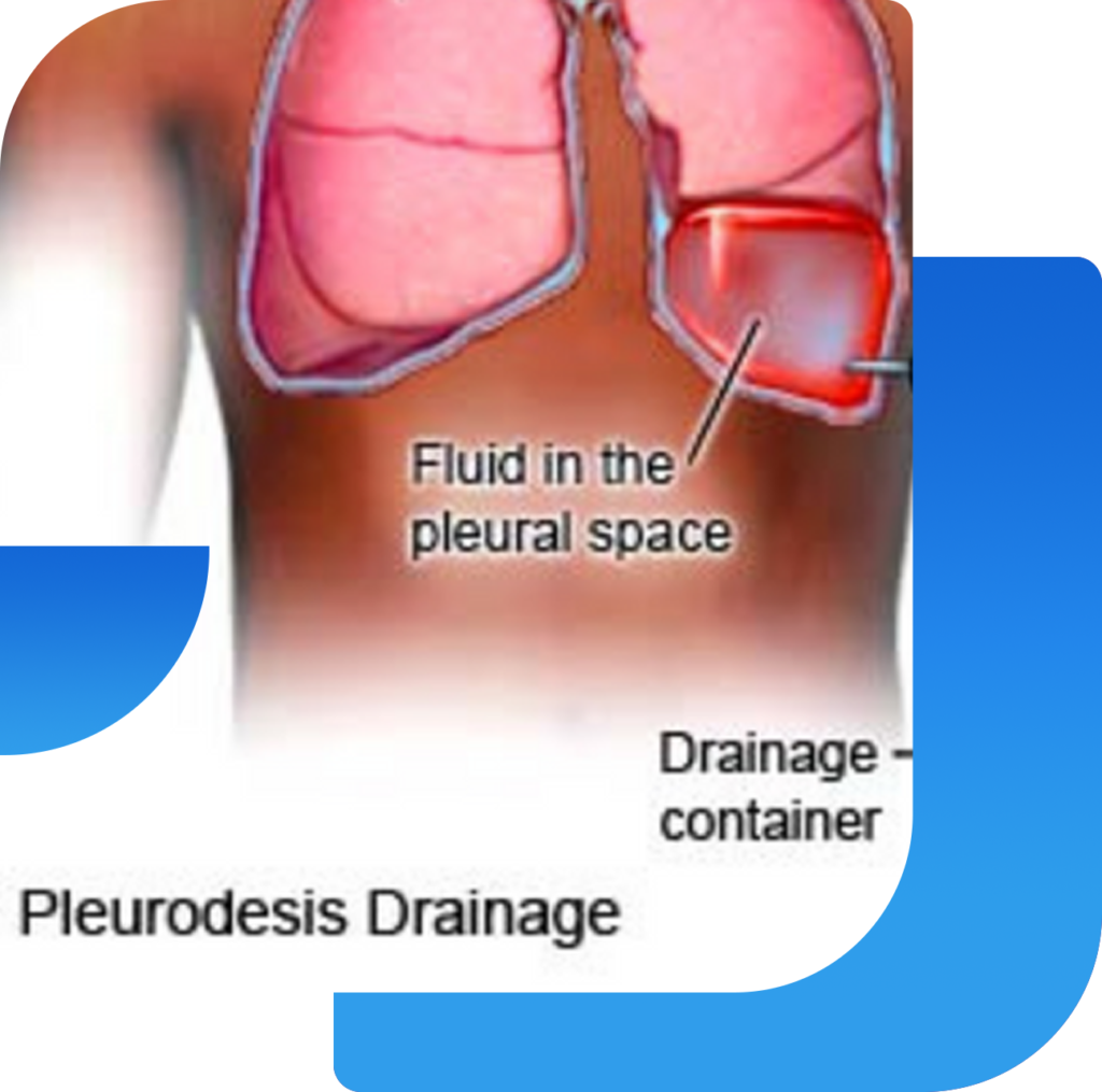 Pleurodesis Dr Vinit Niranjane