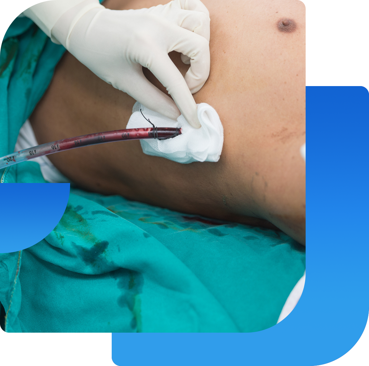 intercostal chest drainage thoracocentasis