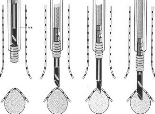 transbronchial needle aspiration