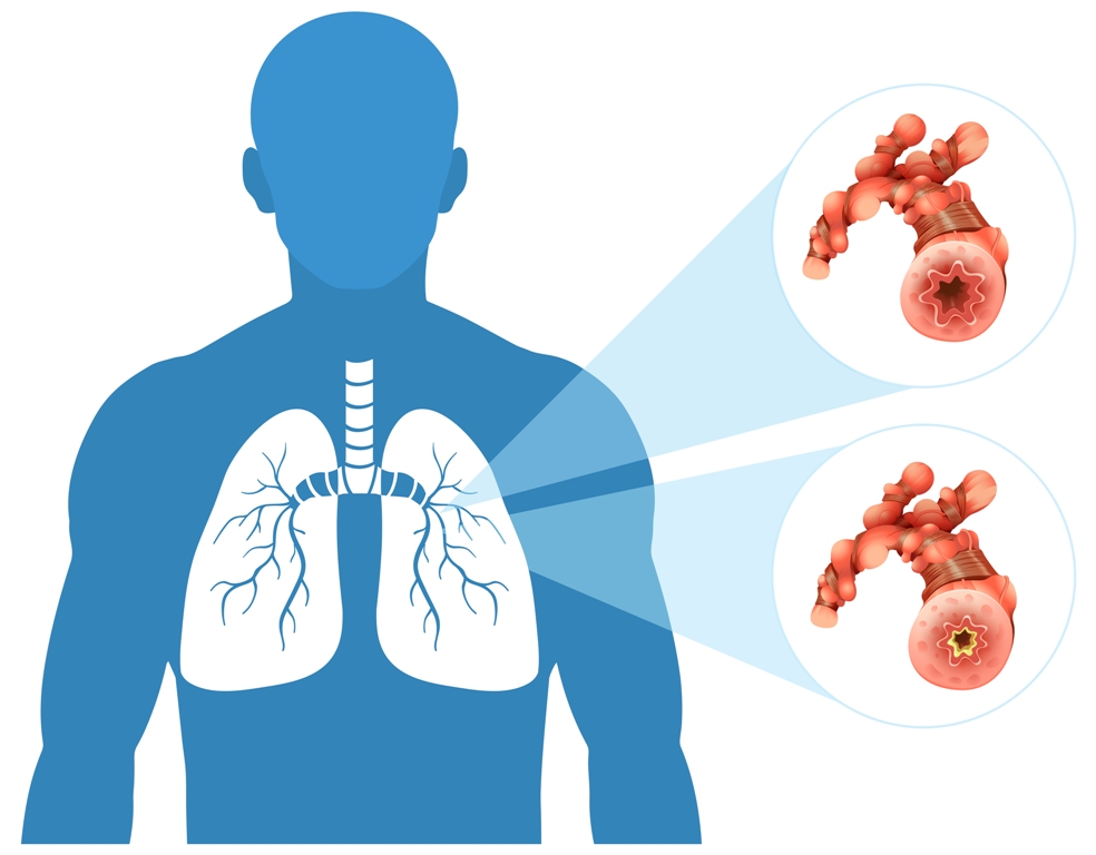 best asthma doctor in Nagpur