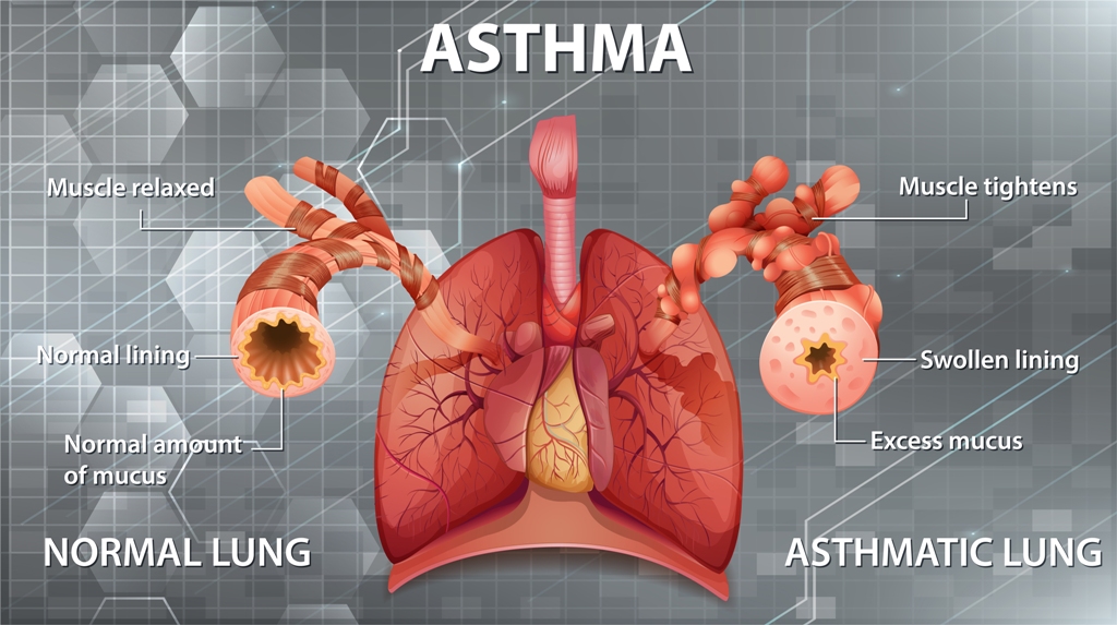 Best Doctor for Asthma Treatment