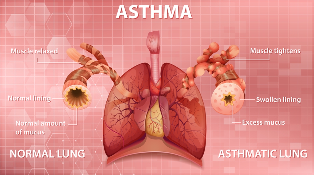 Understanding Asthma: What You Should Know